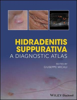 Hidradenitis Suppurativa – A Diagnostic Atlas - G Micali