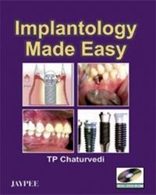 Implantology Made Easy - TP Chaturvedi