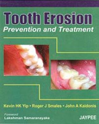 Tooth Erosion Prevention and Treatment - Kevin HK Yip, Roger J Smales, John A Kaidonis