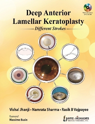 Deep Anterior Lamellar Keratoplasty Different Strokes - 