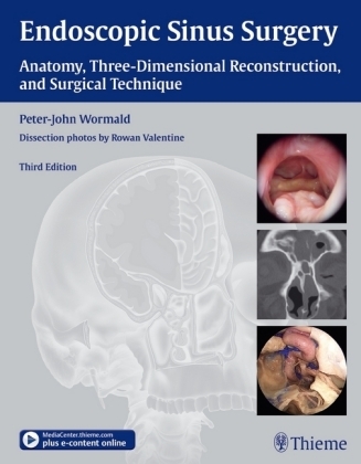 Endoscopic Sinus Surgery - Peter-John Wormald