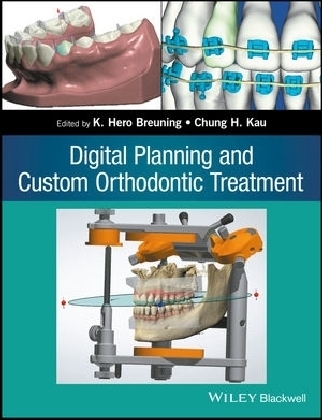 Digital Planning and Custom Orthodontic Treatment - 