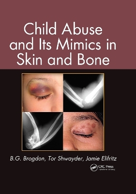 Child Abuse and its Mimics in Skin and Bone - B. G. Brogdon, Tor Shwayder, Jamie Elifritz