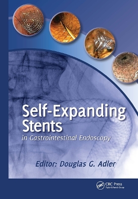 Self-Expanding Stents in Gastrointestinal Endoscopy - Douglas Adler