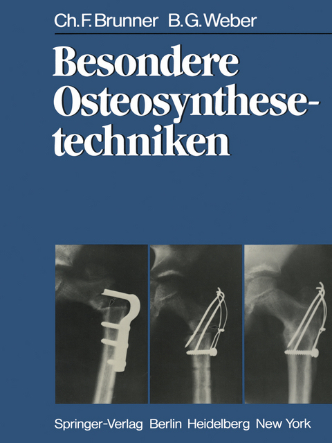 Besondere Osteosynthesetechniken - C. F. Brunner, B. G. Weber