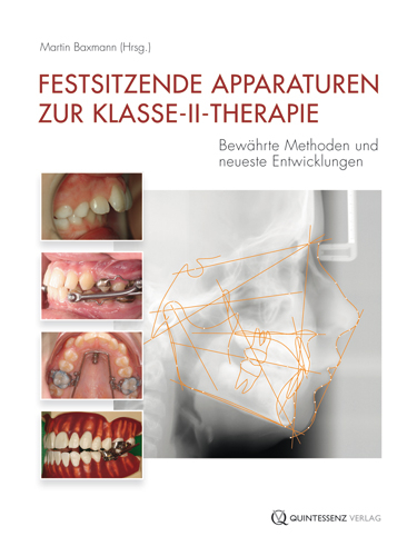 Festsitzende Apparaturen zur Klasse-II-Therapie - 