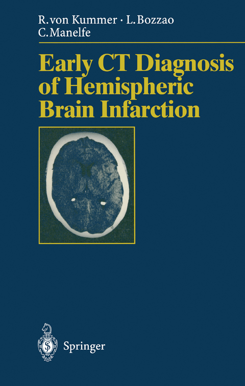 Early CT Diagnosis of Hemispheric Brain Infarction - Rüdiger v. Kummer, Luigi Bozzao, Claude Manelfe