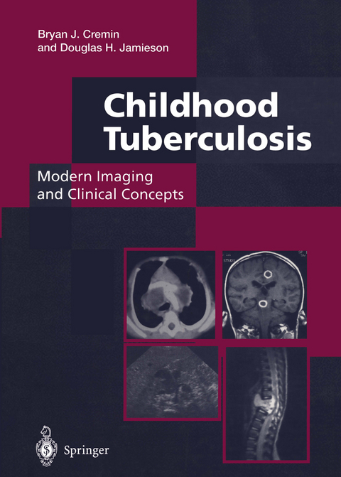 Childhood Tuberculosis: Modern Imaging and Clinical Concepts - Bryan J. Cremin, Douglas H. Jamieson