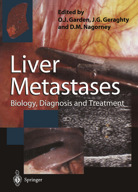 Liver Metastases - 