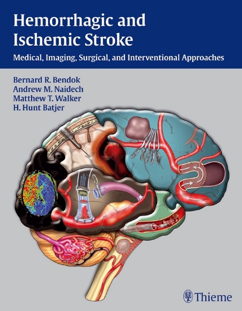 Hemorrhagic and Ischemic Stroke - 