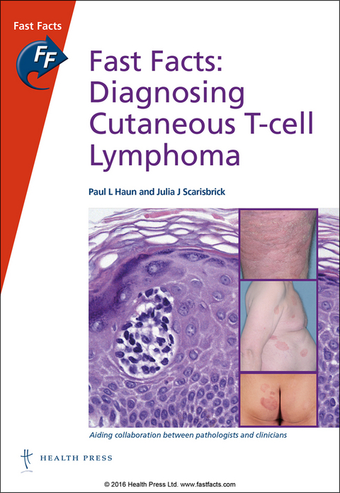Fast Facts: Diagnosing Cutaneous T-cell Lymphoma - Paul L Haun, Julia Scarisbrick