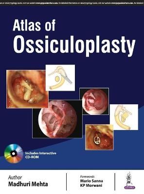 Atlas of Ossiculoplasty - Madhuri Mehta