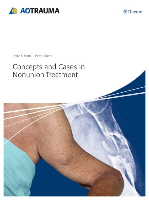 Concepts and Cases in Nonunion Treatment - René K. Marti, Peter Kloen