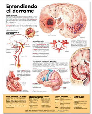 Understanding Stroke Anatomical Chart in Spanish (Entendiendo qué es un derrame)