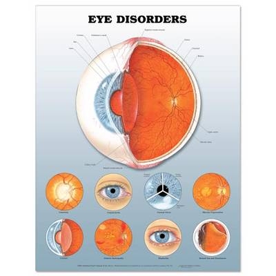 Eye Disorders: 3D Lenticular Chart