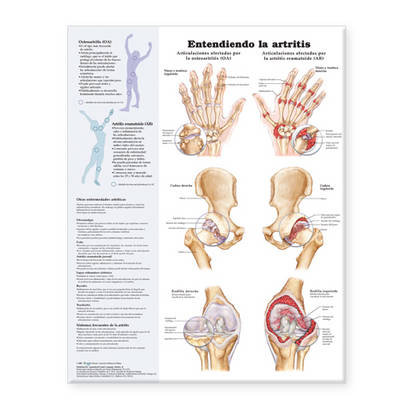 Understanding Arthritis Spanish