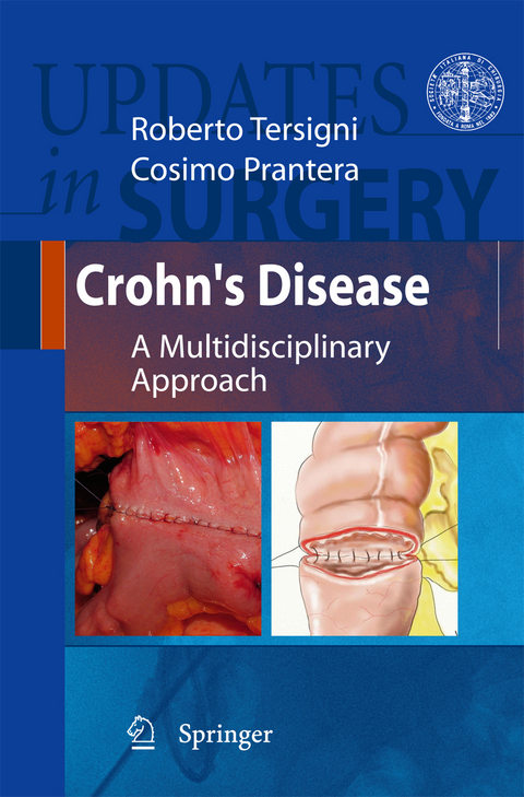 Crohn's Disease - 