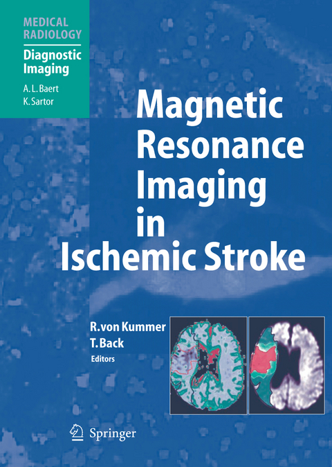 Magnetic Resonance Imaging in Ischemic Stroke - 