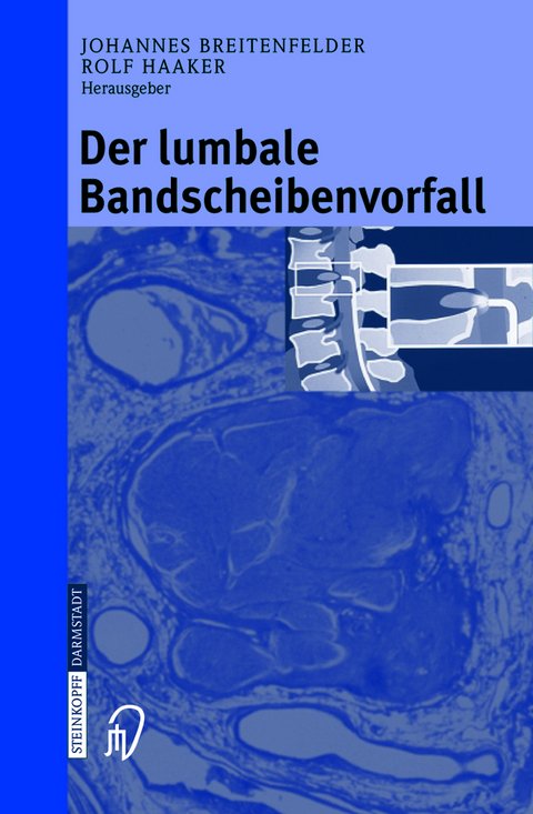 Der lumbale Bandscheibenvorfall - 