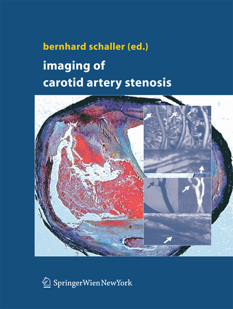 Imaging of Carotid Artery Stenosis - 