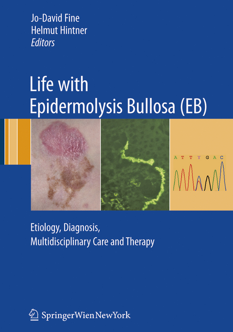 Life with Epidermolysis Bullosa (EB) - 