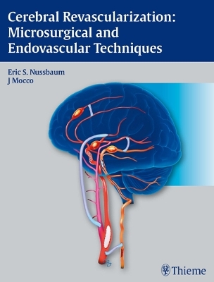 Cerebral Revascularization: Microsurgical and Endovascular Techniques - 