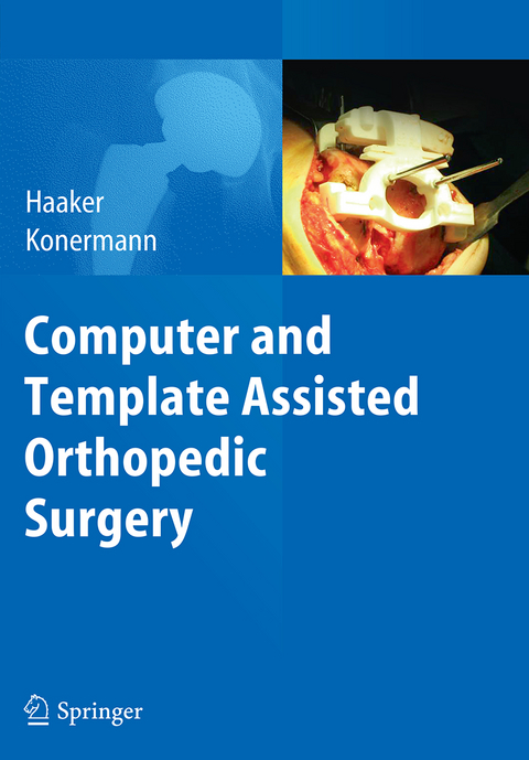 Computer and Template Assisted Orthopedic Surgery - 