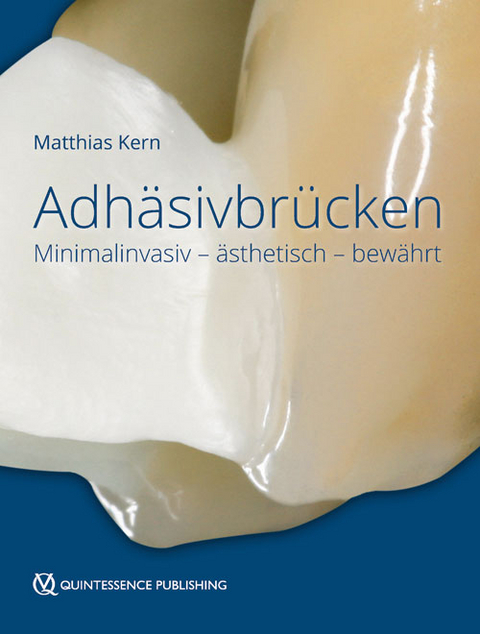 Adhäsivbrücken - Matthias Kern