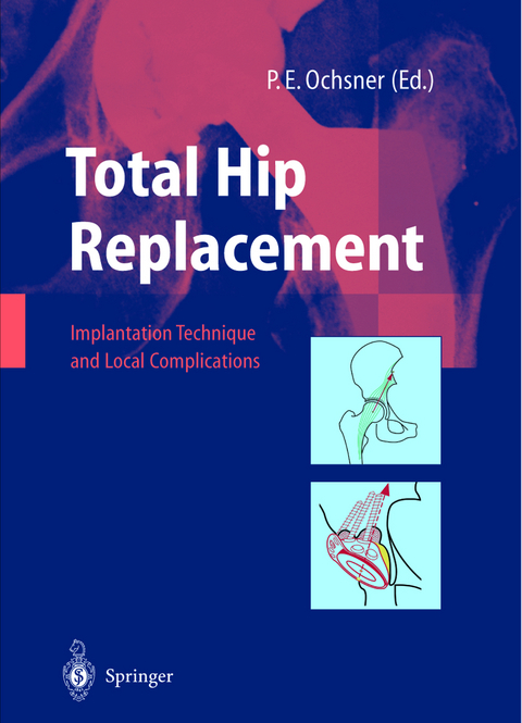 Total Hip Replacement - 