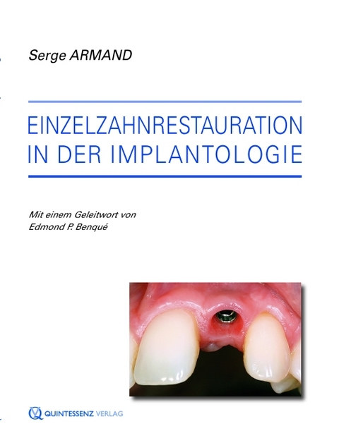 Einzelzahnrestauration in der Implantologie - Serge Armand