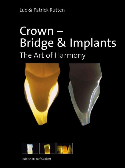 Crown, Bridge & Implants - 
