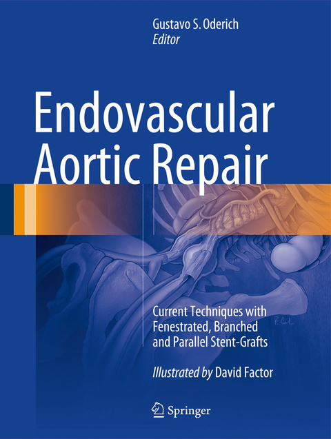 Endovascular Aortic Repair - 