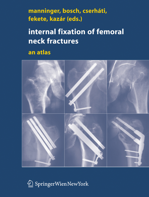 Internal fixation of femoral neck fractures - 
