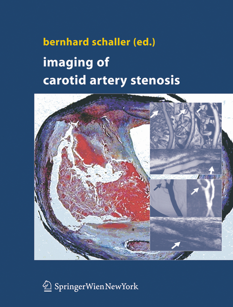 Imaging of Carotid Artery Stenosis - 