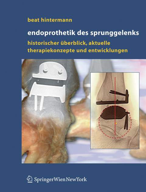 Endoprothetik des Sprunggelenks - Beat Hintermann