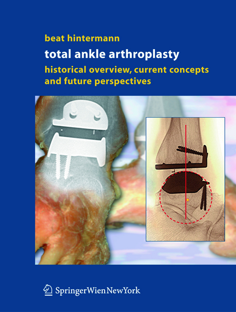 Total Ankle Arthroplasty - Beat Hintermann