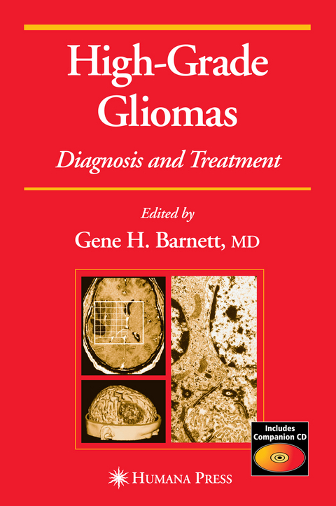 High-Grade Gliomas - 