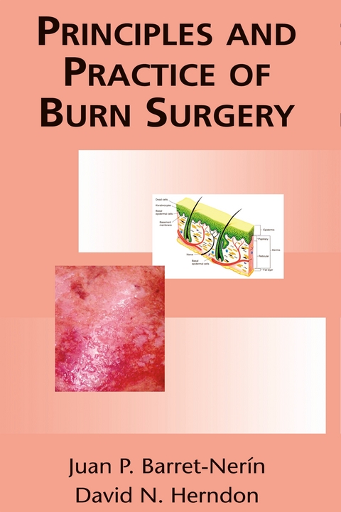 Principles and Practice of Burn Surgery - 