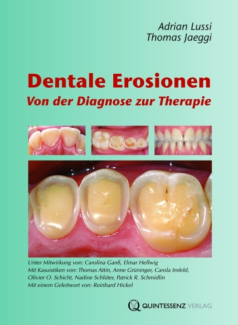 Dentale Erosionen - Thomas Jaeggi, Adrian Lussi