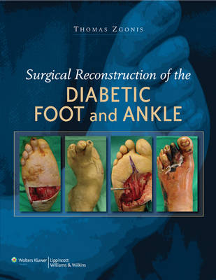 Surgical Reconstruction of the Diabetic Foot and Ankle - 