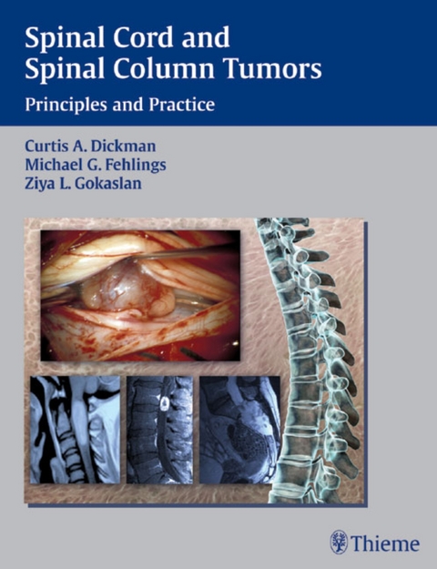 Spinal Cord and Spinal Column Tumors - 