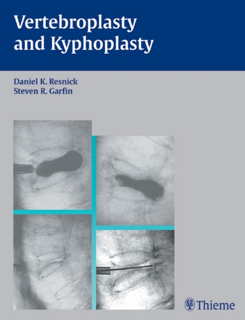 Vertebroplasty and Kyphoplasty - 