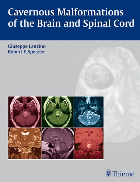 Cavernous Malformations of the Brain and Spinal Cord - 