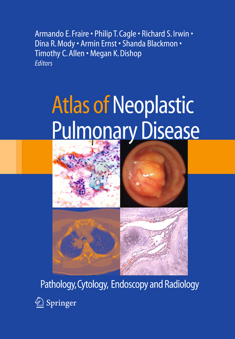 Atlas of Neoplastic Pulmonary Disease - 