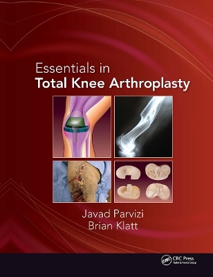 Essentials in Total Knee Arthroplasty - Javad Parvizi, Brian Klatt