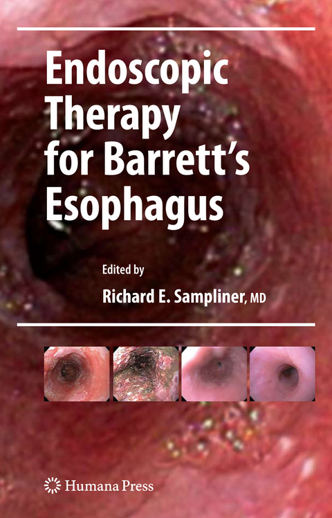 Endoscopic Therapy for Barrett's Esophagus - 