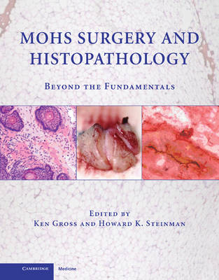 Mohs Surgery and Histopathology - 