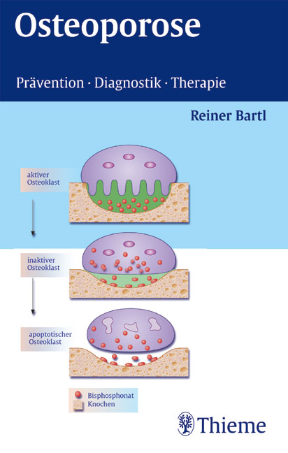 Osteoporose - Reiner Bartl