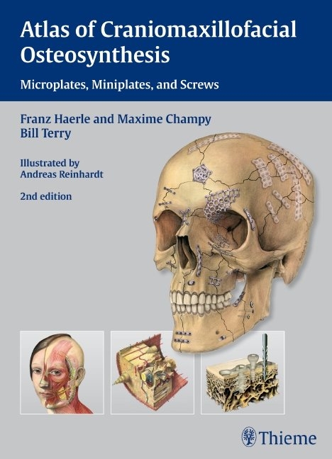 Atlas of Craniomaxillofacial Osteosynthesis - Franz Härle, Maxime Champy, Bill Terry