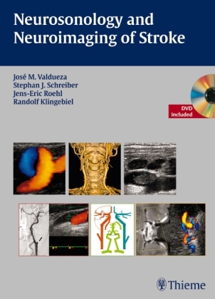 Neurosonology and Neuroimaging of Stroke - José Manuel Valdueza, Stephan Schreiber, Jens-Eric Röhl, Randolf Klingebiel